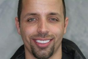 Invisalign clear braces patient