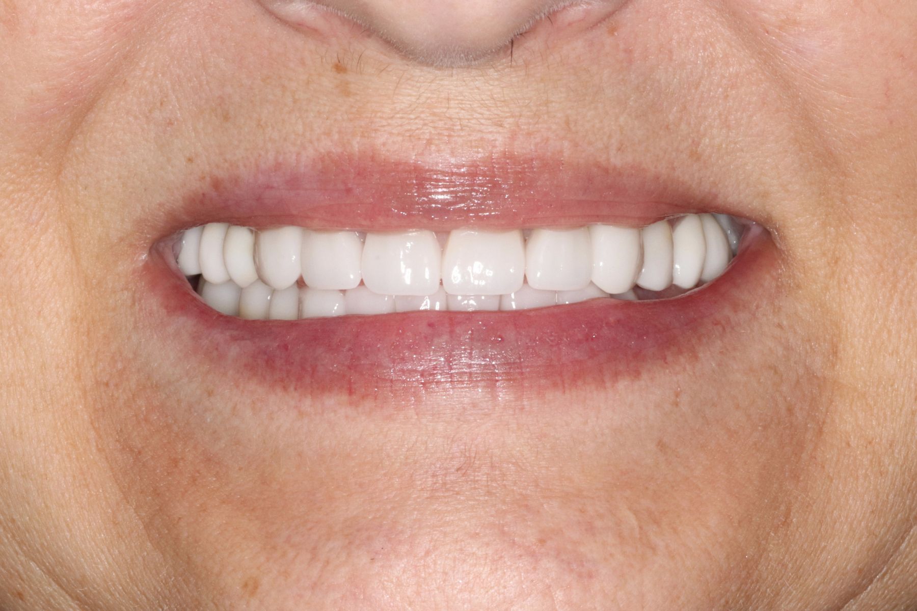 Restoring Confidence Through Dental Transformation