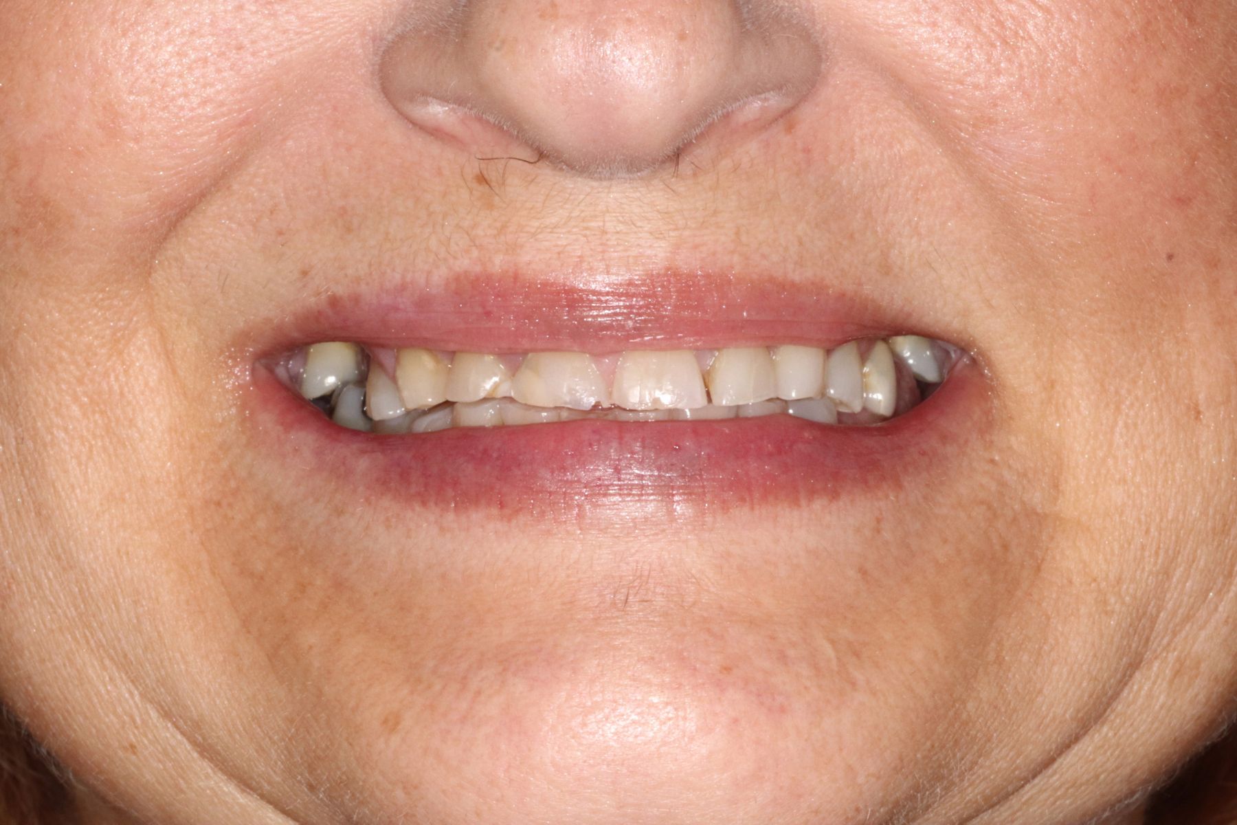 Restoring Confidence Through Dental Transformation