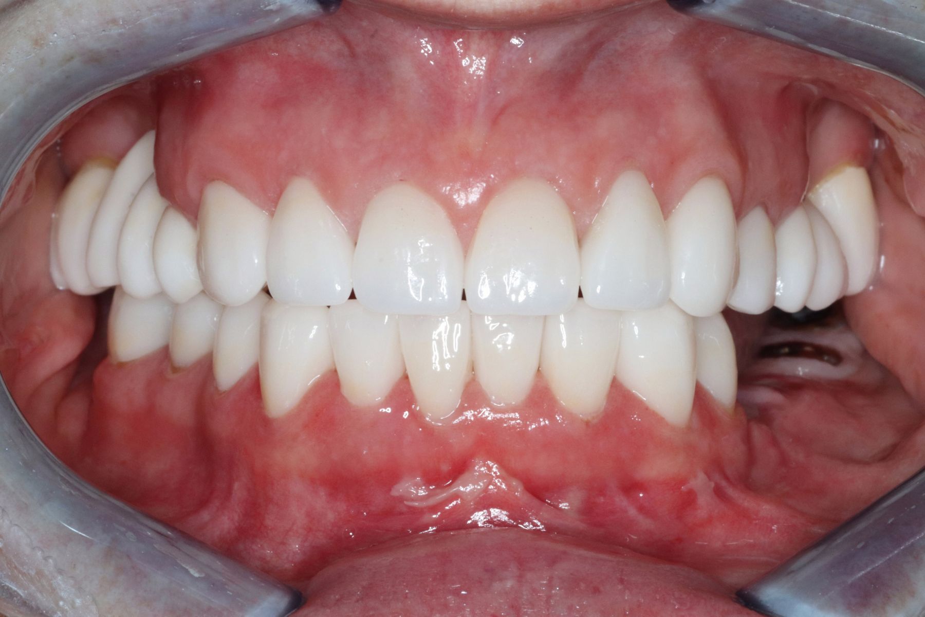 Restoring Confidence Through Dental Transformation