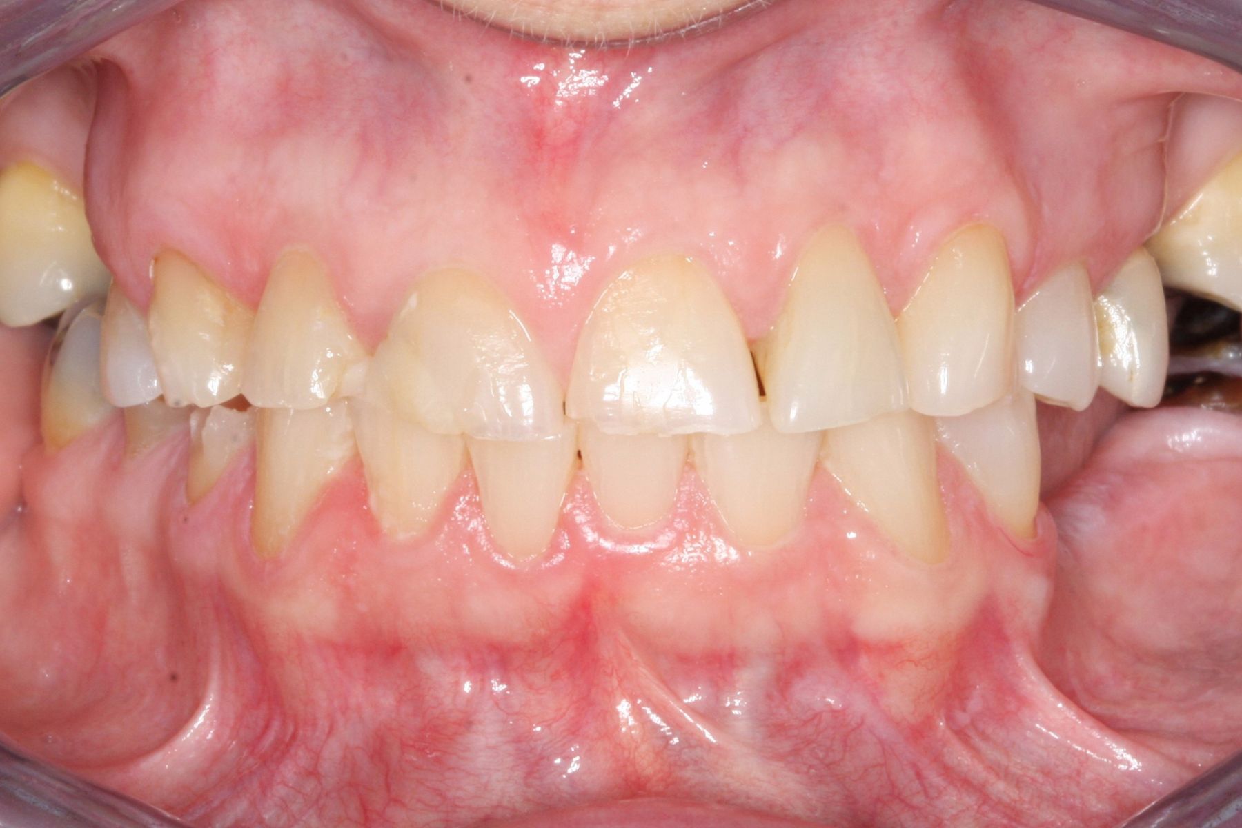 Restoring Confidence Through Dental Transformation