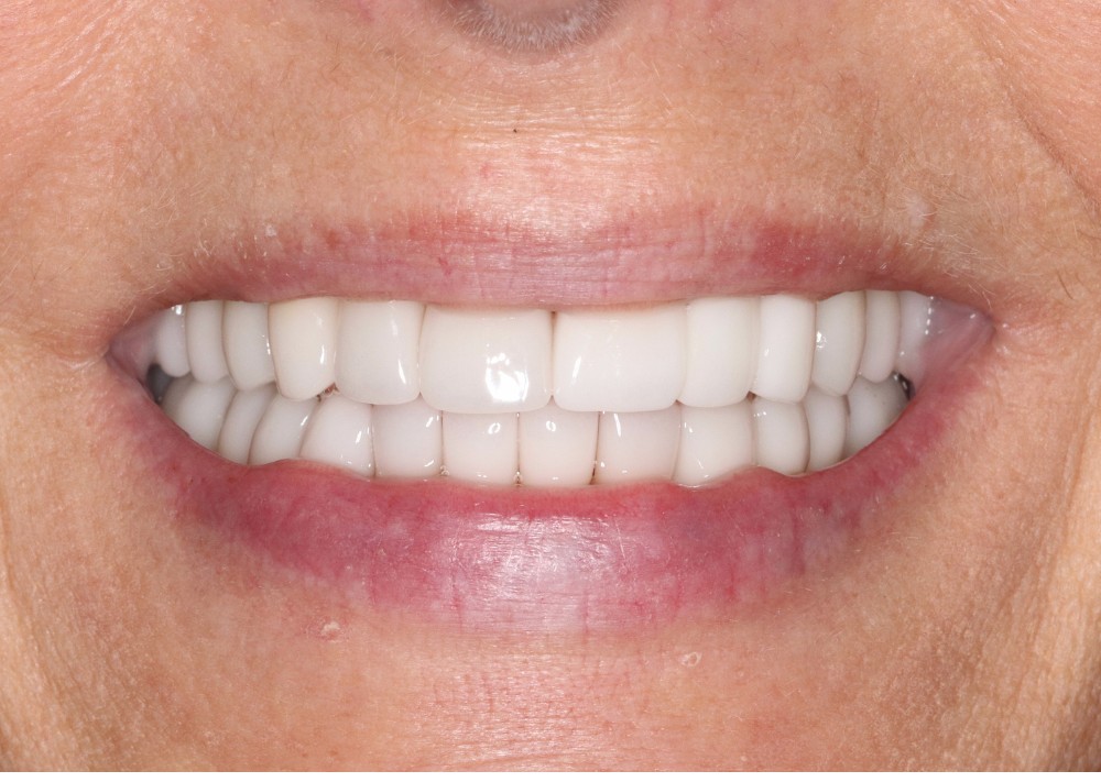 Full Mouth Reconstruction For TMD Relief