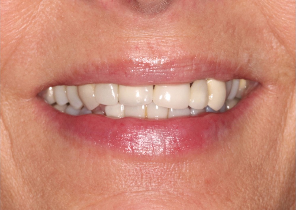 Full Mouth Reconstruction For TMD Relief